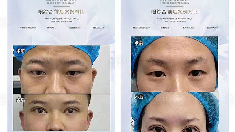 热玛吉：揭秘这项抗衰老技术适合哪些肤质人群