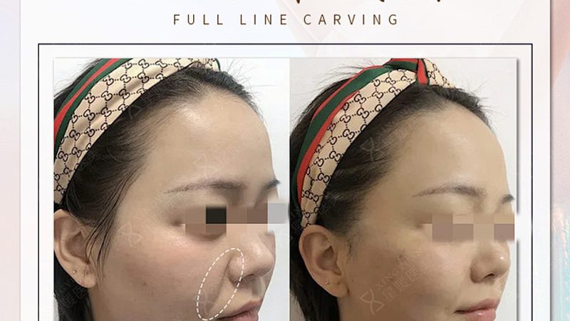 激光祛斑后皮肤干到起皮？问题出在补水方式上