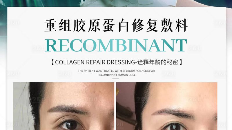 肉毒素去抬头纹，安全吗？揭秘注射细节与注意事项