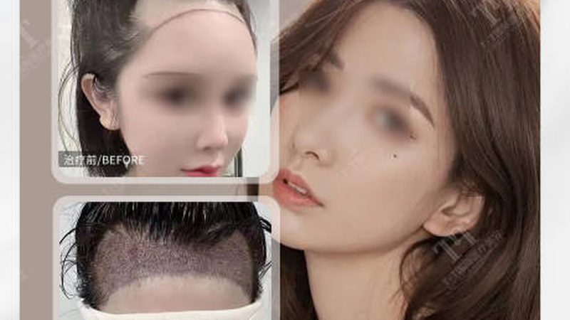 成都面部提升手术，费用背后的秘密