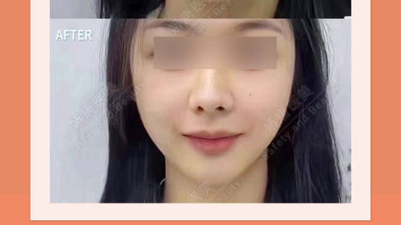 超声炮效果能维持多久？揭秘维持时间的秘密**