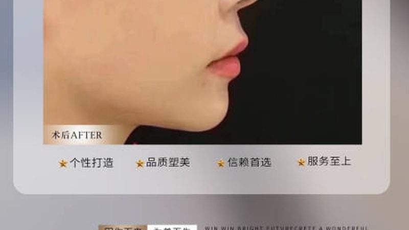 埋线提升，揭秘品牌前十名背后的技术奥秘