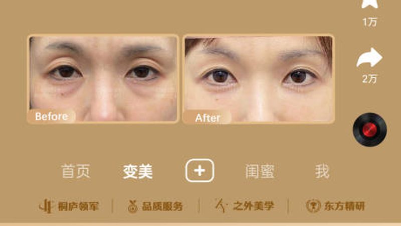 小标题：进口肉毒素的优势