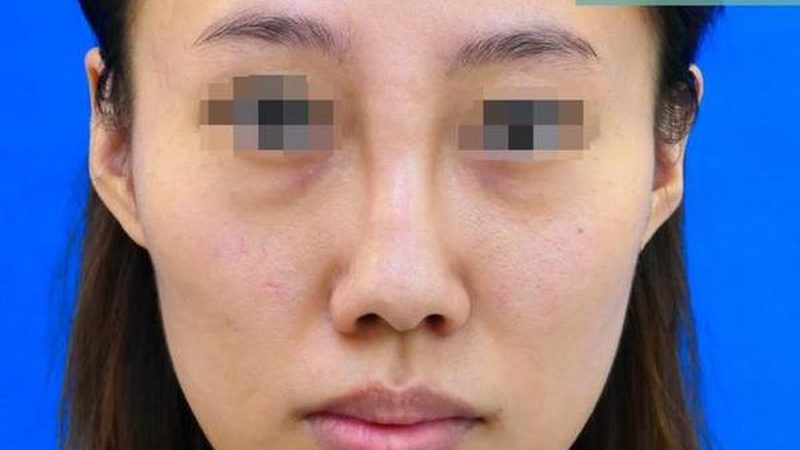 进口医美耗材批发价格